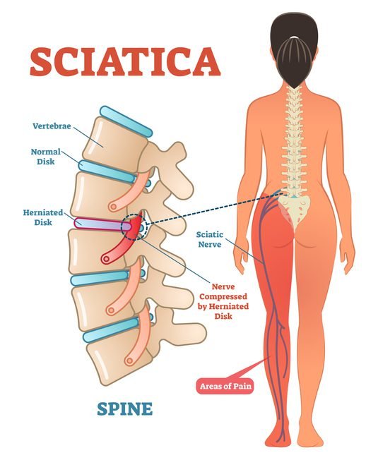 Sciatica Pain Physiotherapy in Kanpur. When should you visit?